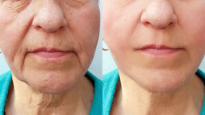 picture of woman's chin area, before & after filler treatments