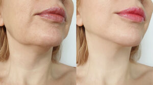 picture of woman's chin area, before & after filler treatments
