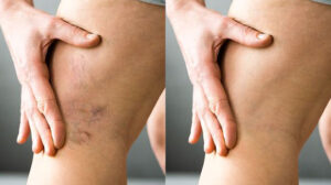 before and after picture of the back of a woman's knee with & without varicose veins